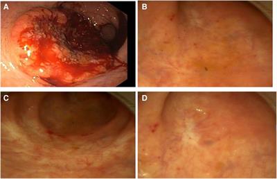 Personalized medicine for locally advanced rectal cancer: five years of complete clinical response after neoadjuvant radiochemotherapy—a case report with a literature review